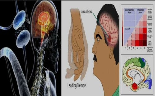 পারকিনসনস রোগ এর চিকিৎসা ও প্রতিকার! 