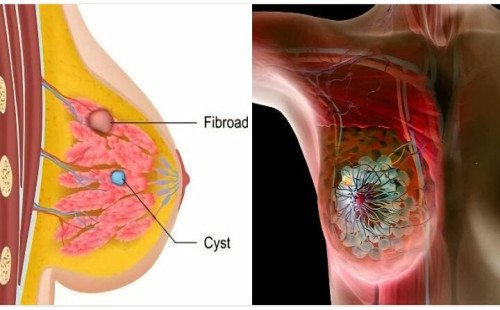 ব্রেস্ট ক্যান্সার ও প্রতিকার 